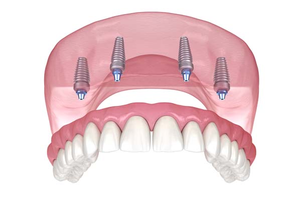 All On   : Replace All Top Teeth In A Day