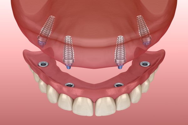 All-on-4 Dental Implants Woodstock, GA