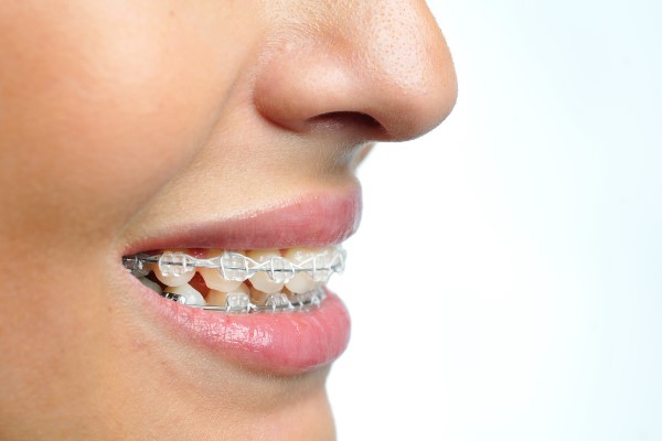 FAQs About Clear Braces Treatment