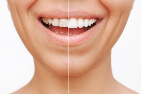 Cosmetic Dentistry Treatments To Improve The Appearance Of Your Teeth