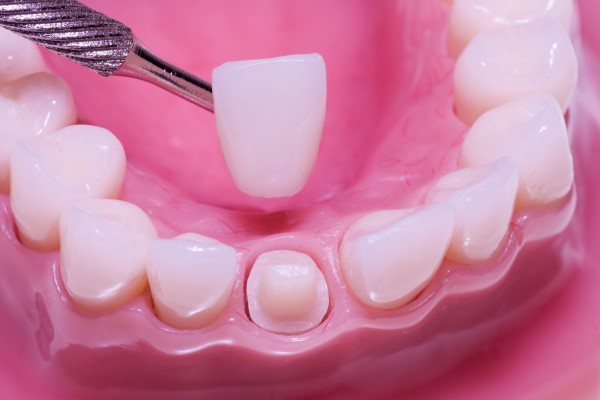 Can A Dental Crown Save Your Tooth?