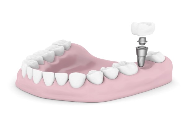 What Does The Process For Dental Implants Involve?