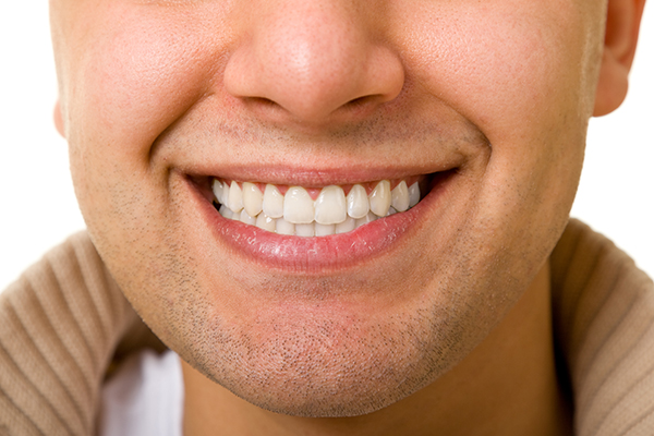 Facts About Dental Veneers