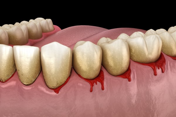 When Is Gum Disease Treatment Necessary?