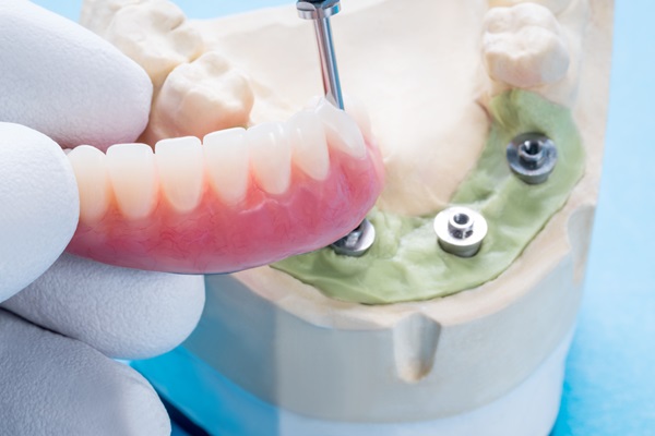 A Guide To The Implant Supported Dentures Procedure