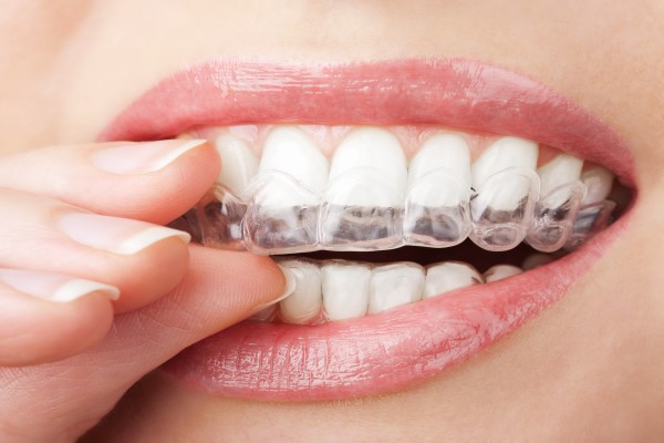 What To Expect After Your Completing Treatment From An Invisalign Dentist