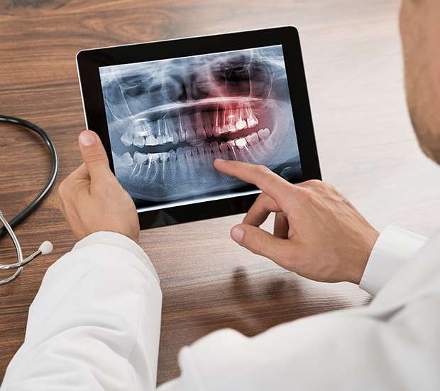 Woodstock Types of Dental Root Fractures